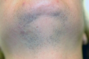 Undershot of a man's chin before hair removal