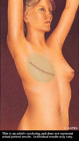 Animated diagram of a the scar placement of a breast reconstruction patient