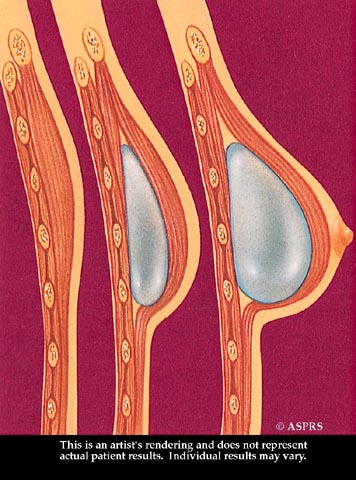 Animated diagram showing the process of an implant placed in a breast for reconstruction surgery