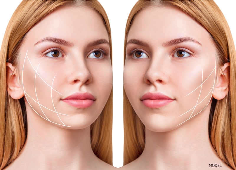 Two angles of young woman with lines drawn on the SMAS portion of her face.